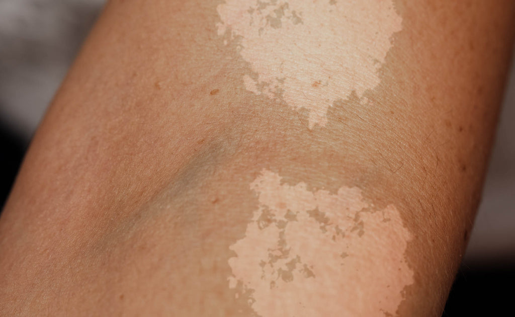 How to treat Tinea Versicolour at home