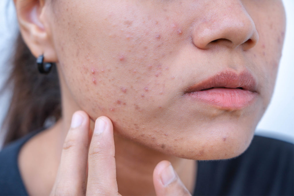 How to clear acne naturally at home